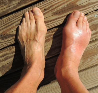 image.png 통풍 관리 안하다가 발가락 뼈 녹기 싫으면 봐야할..입문서. jpg