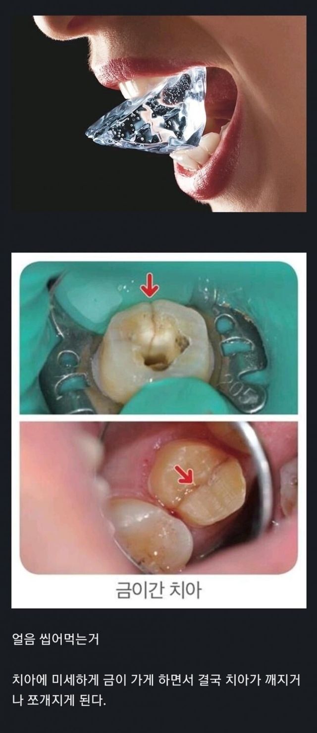 1.jpg 치아 수명 줄이는 최악의 행위