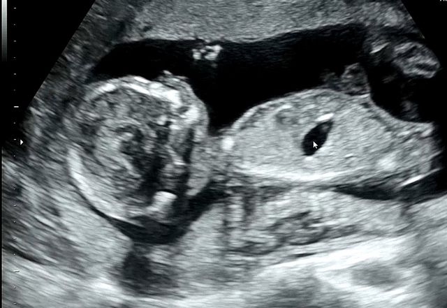 유산 후에 아기천사가 다시 찾아와줬네요.