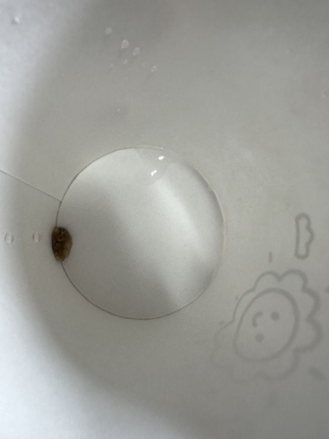 IMG_6071.jpeg 내 자연배출 요로결석(돌사진있음)