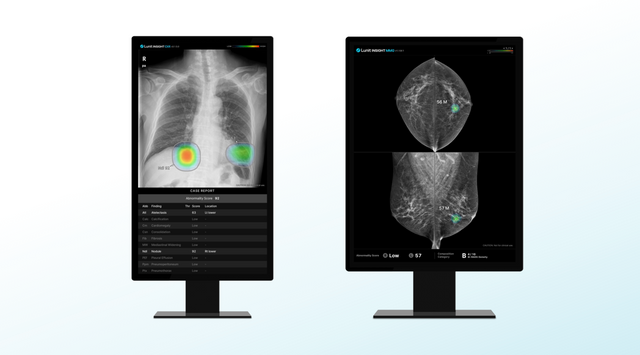 루닛 흉부 엑스레이 AI 영상분석 솔루션 ‘루닛 인사이트 CXR’(왼쪽)과 유방촬영술 AI 상분석 솔루션 ‘루닛 인사이트 MMG’. [사진=루닛]