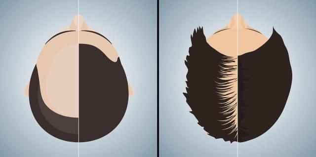 An illustration compares typical male and female hair loss patterns showing a receding hairline and crown thinning in men alongside more diffuse thinning across the scalp in women Courtesy of Yonhap News Agency