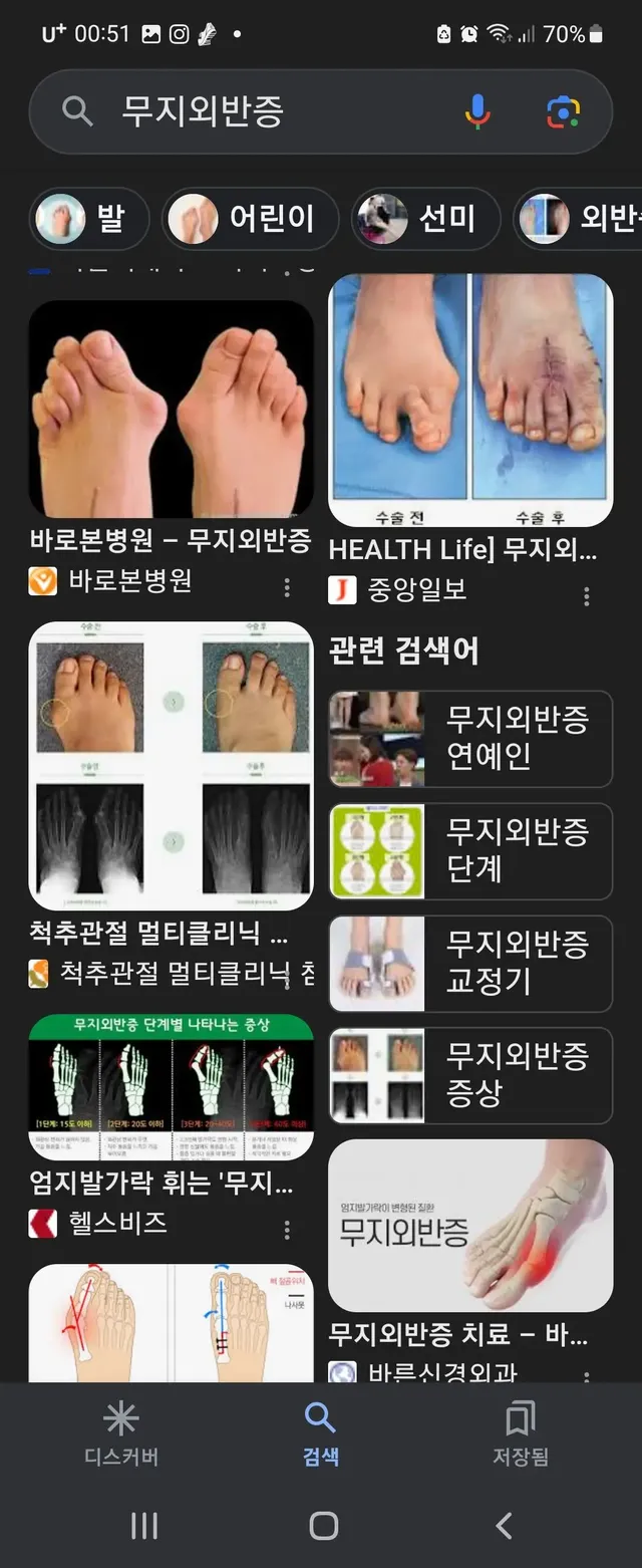 하이힐 신으면 생기는 발 질병 | mbong.kr 엠봉