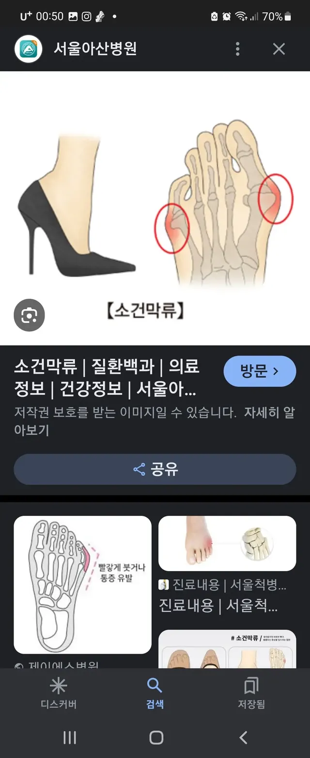 하이힐 신으면 생기는 발 질병 | mbong.kr 엠봉