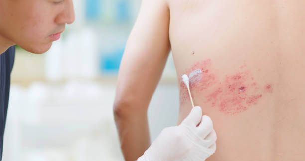 이 이미지는 대상포진 초기 증상에 관한 포스팅을 설명하기 위한 참고 사진입니다.