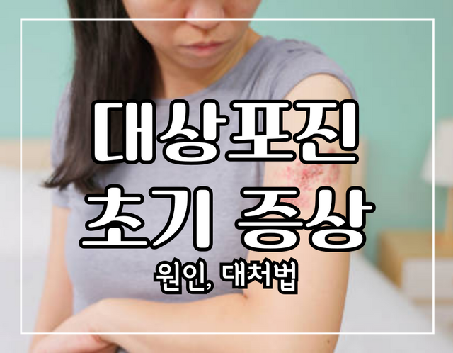 이 이미지는 대상포진 초기증상에 관한 포스팅의 대표 이미지입니다.