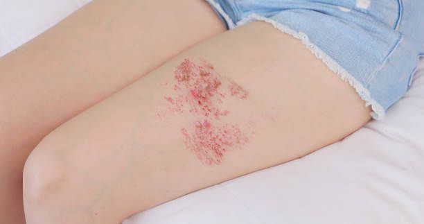 이 이미지는 대상포진 초기 증상에 관한 포스팅을 설명하기 위한 참고 사진입니다.