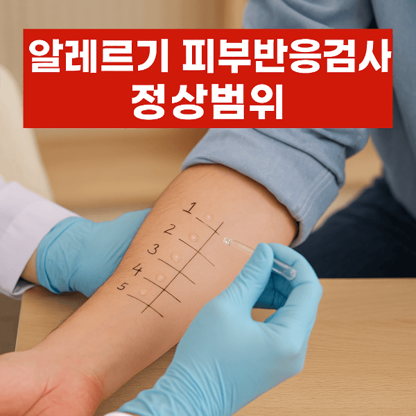 알레르기 피부반응검사 정상범위 썸네일