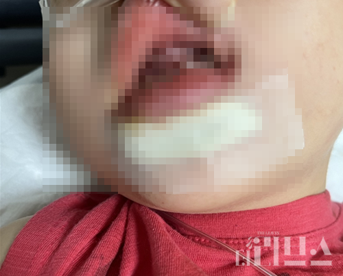 대교 '트니트니'에서 낙상 사고가 발생해 부상을 입은 아이. [사진=제보자 제공]