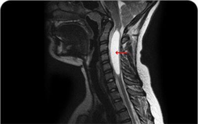 [이미지1] 척수공동증