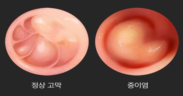 일반 고막과 중이염 고막(사진=닥터나우)