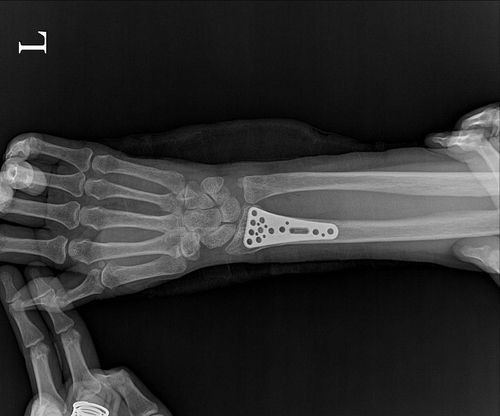 몸속에 남겨둔 철판[피해자 측 제공. 재판매 및 DB 금지] / 사진 = 연합뉴스