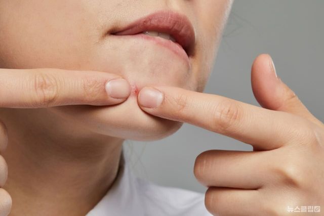 ⓒ게티이미지뱅크(여드름)