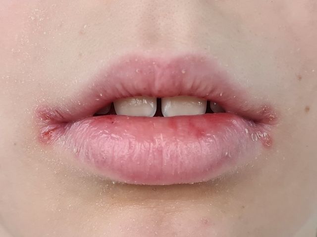 ⓒ게티이미지뱅크(입 건조)