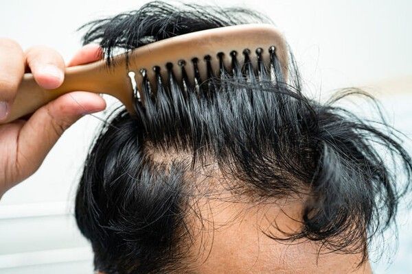 ⓒ게티이미지뱅크(탈모)