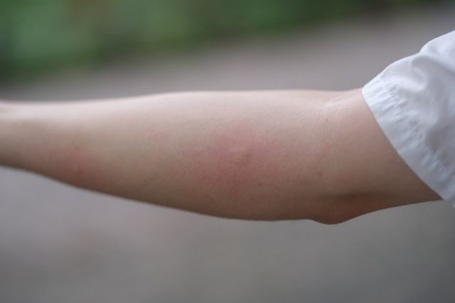 ⓒ게티이미지뱅크(모기물린 사람)