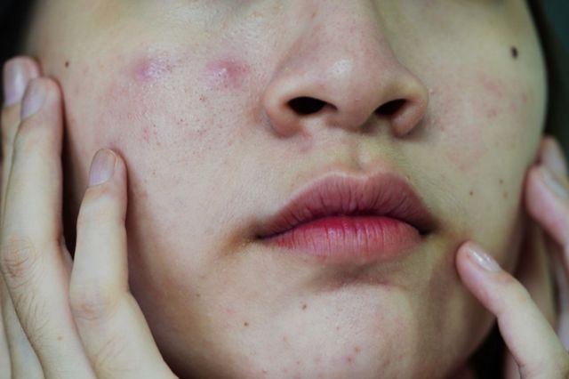 ⓒ게티이미지뱅크(피부트러블)