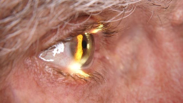 ⓒ게티이미지뱅크(백내장)