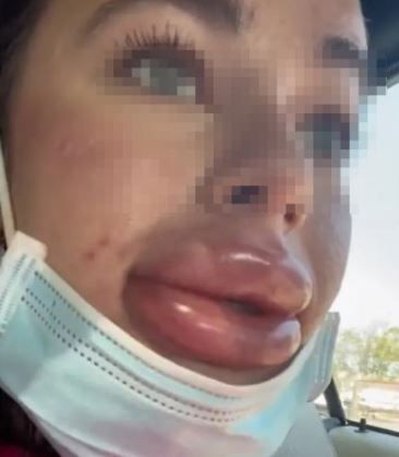 무료 입술필러 맞고 오리입술 된 인플루언서 / 사진= 틱톡