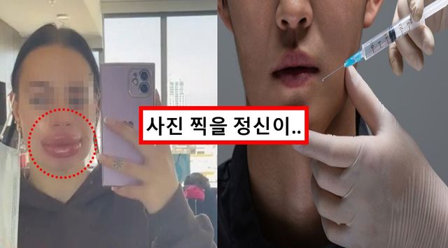 무료 입술필러 맞고 오리입술 된 인플루언서 / 사진= 틱톡, 게티이미지뱅크