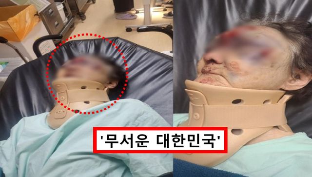 폭행 당한 80대 치매 할머니
