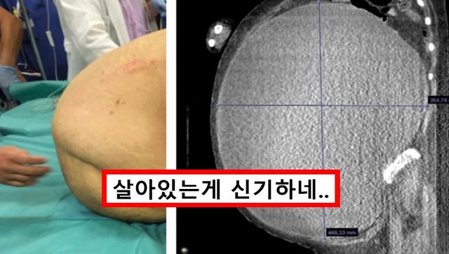 수술전 복부사진과 CT 사진