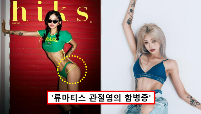 최준희 골반 괴사