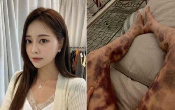 아옳이 피멍 병원 건강주사 의료사고 소송