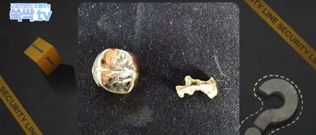 치과 치료후 나온 금이빨을 길거리 매입업체에 팔면 안되는 이유