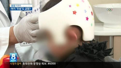 흔한 교정기.jpg