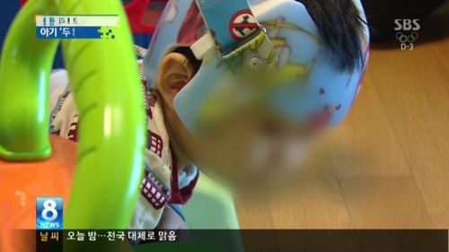 흔한 교정기.jpg