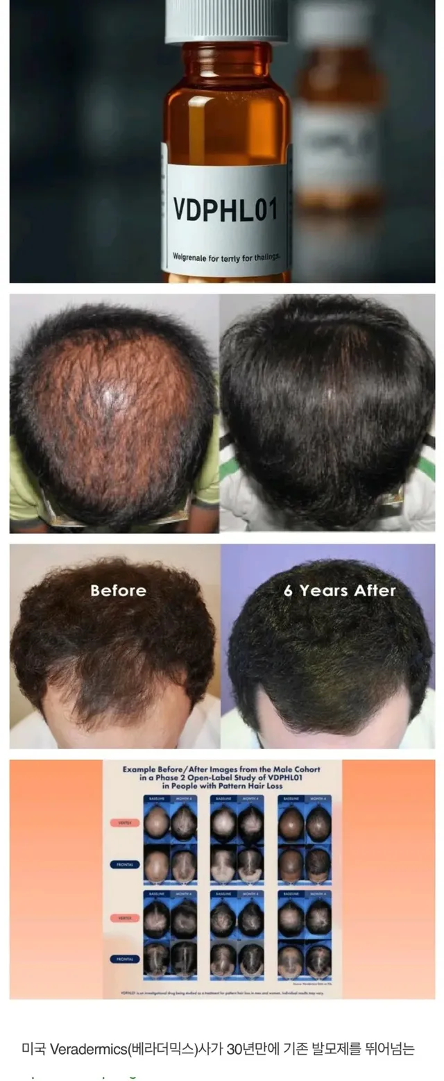 탈모인들 희소식 ㅋㅋㅋㅋ