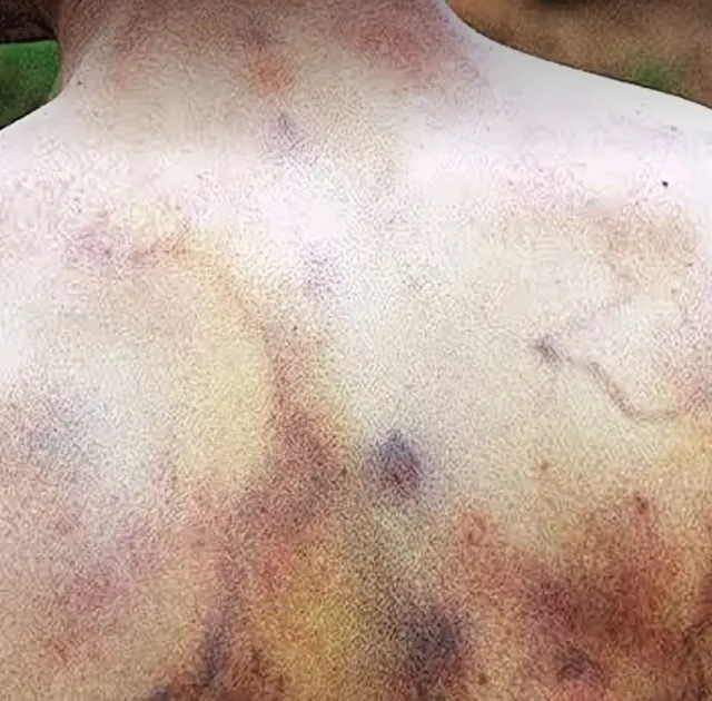 번개 맞은후 피부 변화