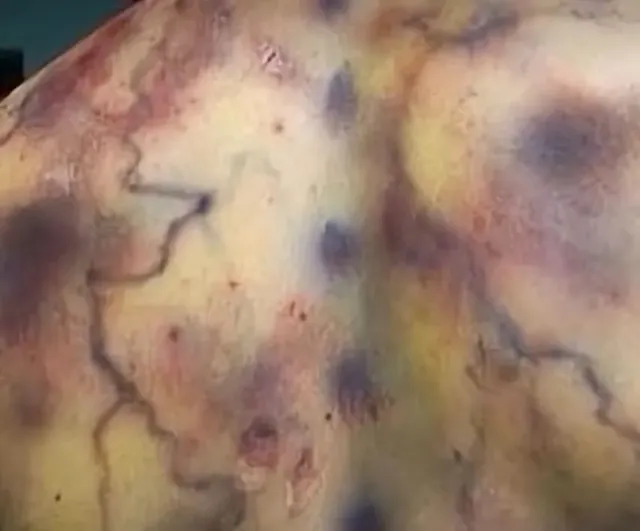 번개 맞은후 피부 변화