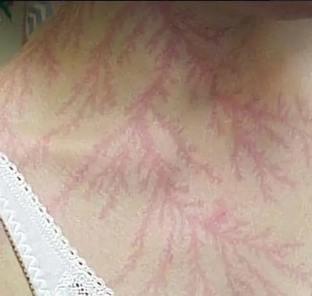 번개 맞은후 피부 변화