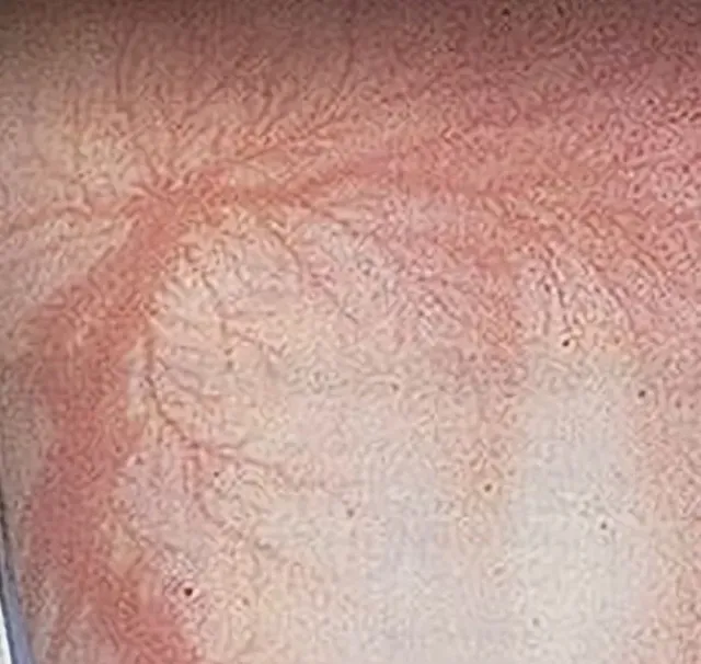 번개 맞은후 피부 변화