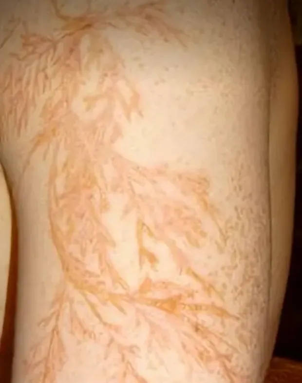 번개 맞은후 피부 변화