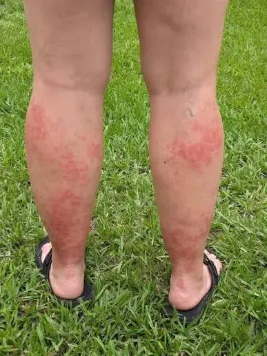 많은 미국인들이 디즈니에 가면 걸린다는병