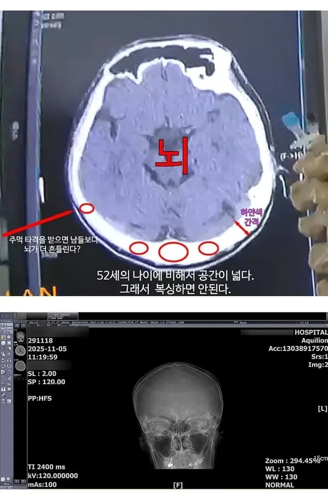 복싱 하지 말라는데 의사 말이 틀린 거 같다며 하겠다는 52살