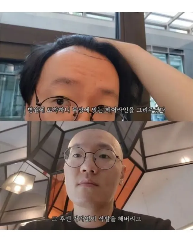 터키로 모발이식 받으러간 남성