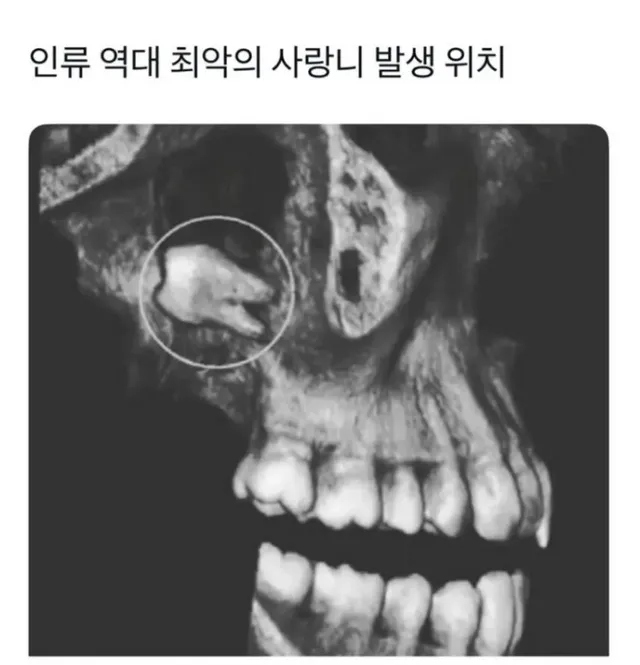 인류 역대 최악의 사랑니 위치