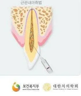 치과에서 가장 아프다는거