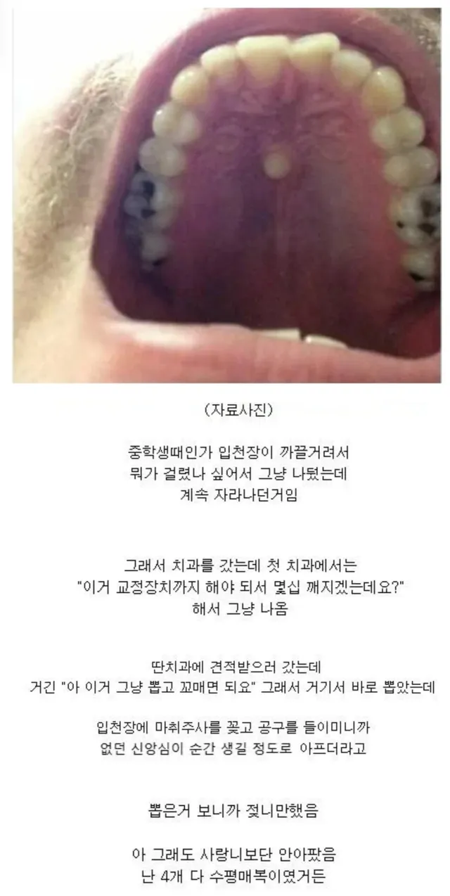 입천장에 뭐가 나서 치과에 갔더니...