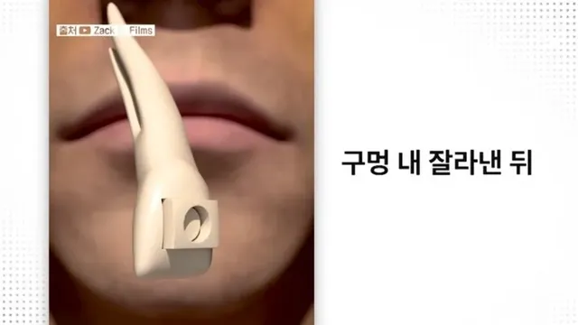 눈에 치아를 넣어 시력을 회복하는 수술