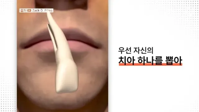 눈에 치아를 넣어 시력을 회복하는 수술