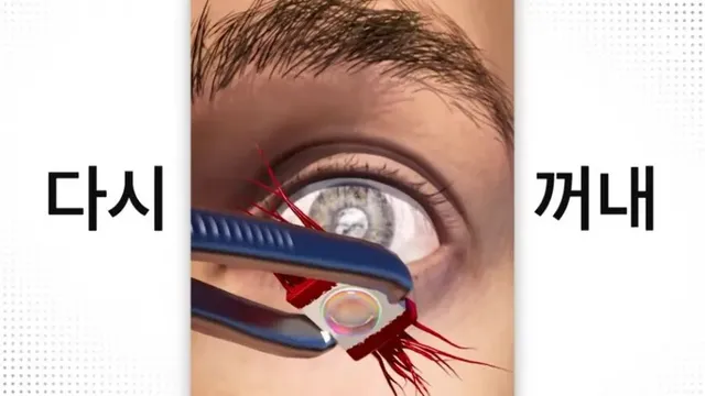 눈에 치아를 넣어 시력을 회복하는 수술