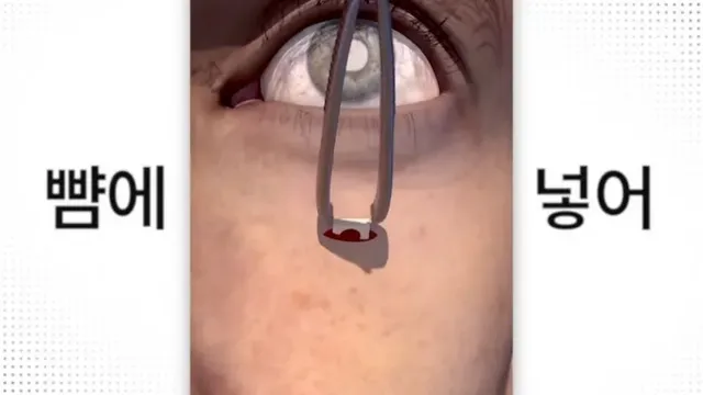 눈에 치아를 넣어 시력을 회복하는 수술