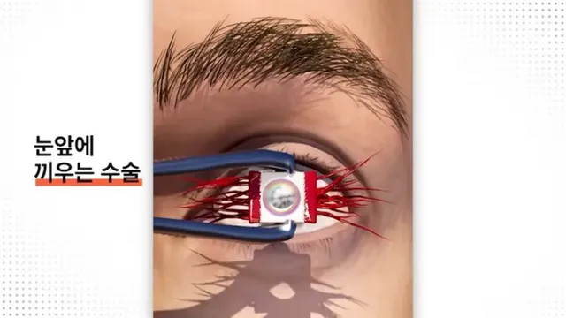 눈에 치아를 넣어 시력을 회복하는 수술
