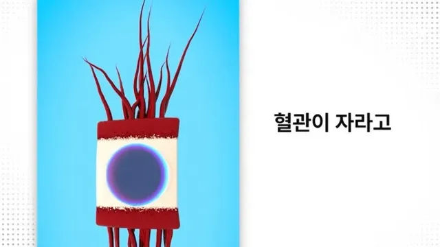 눈에 치아를 넣어 시력을 회복하는 수술
