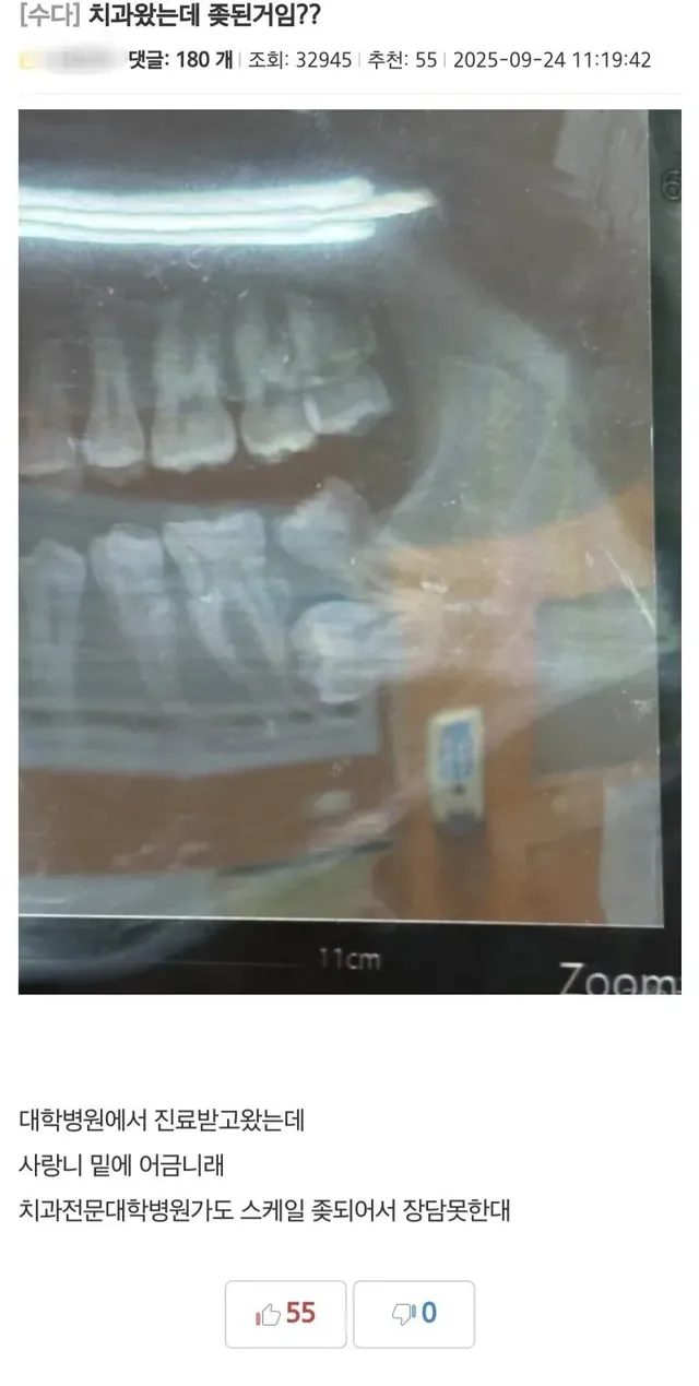 치과왔는데 사랑니 이거 ㅈ된거임?